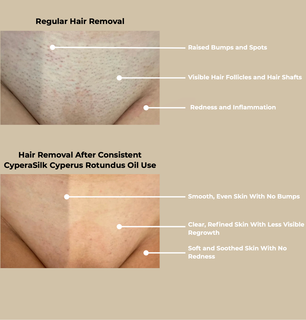 CyperaSilk Cyperus Rotundus Hair Reduction Oil